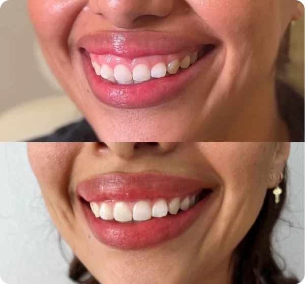 SEV Laser Botox Irvine