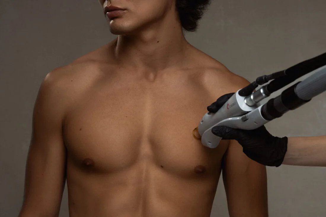 SEV Laser Hair Removal for an Active Lifestyle