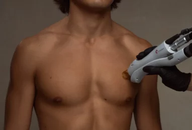 Laser Hair Removal For Pilonidal Cysts
