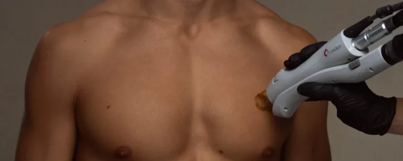 Laser Hair Removal For Pilonidal Cysts