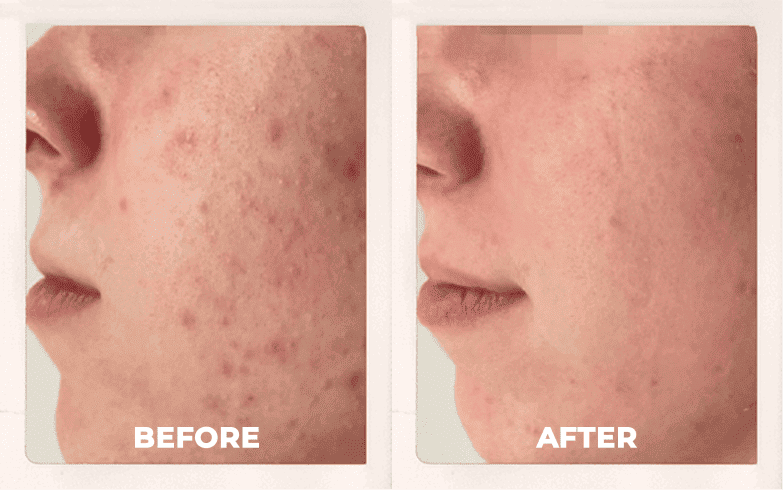 laser facial treatment for acne