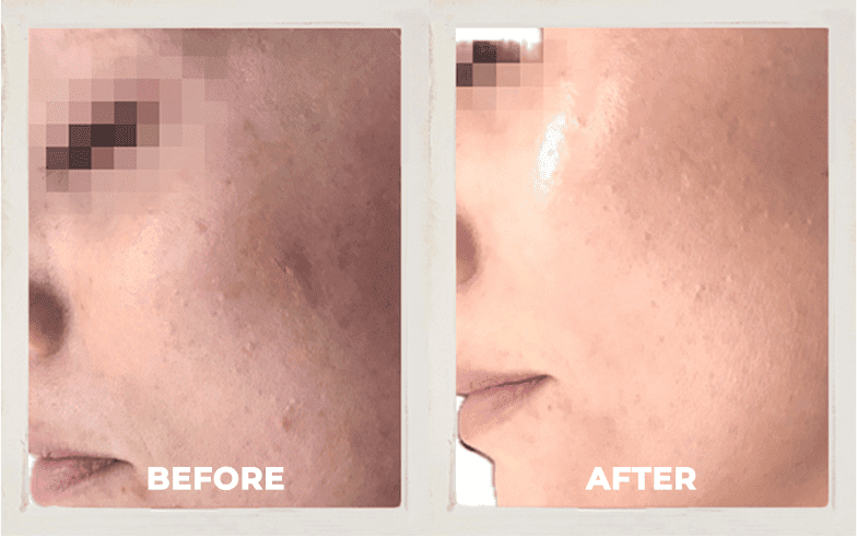 Before and After laser facial treatment