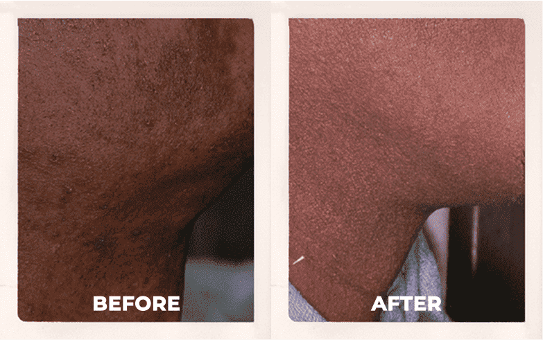 Before and After laser facial