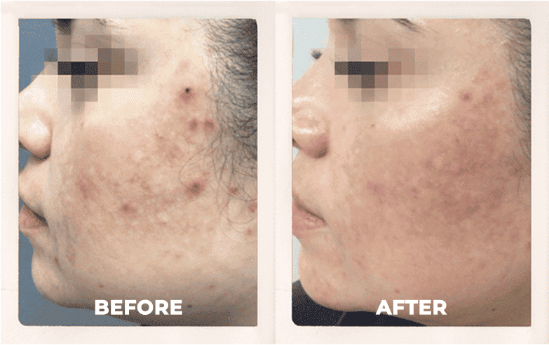 before and after laser facial for acne and hyperpigmentation