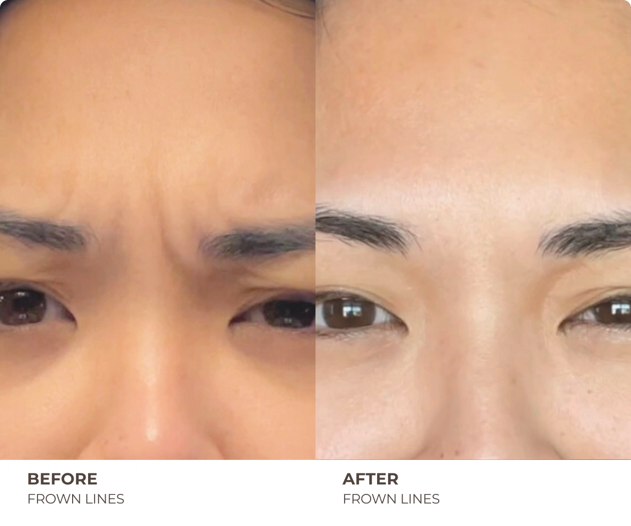 forhead filler before and after