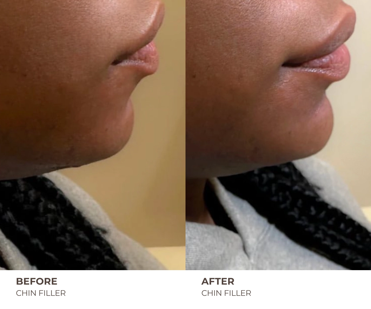 chin fillers before and after