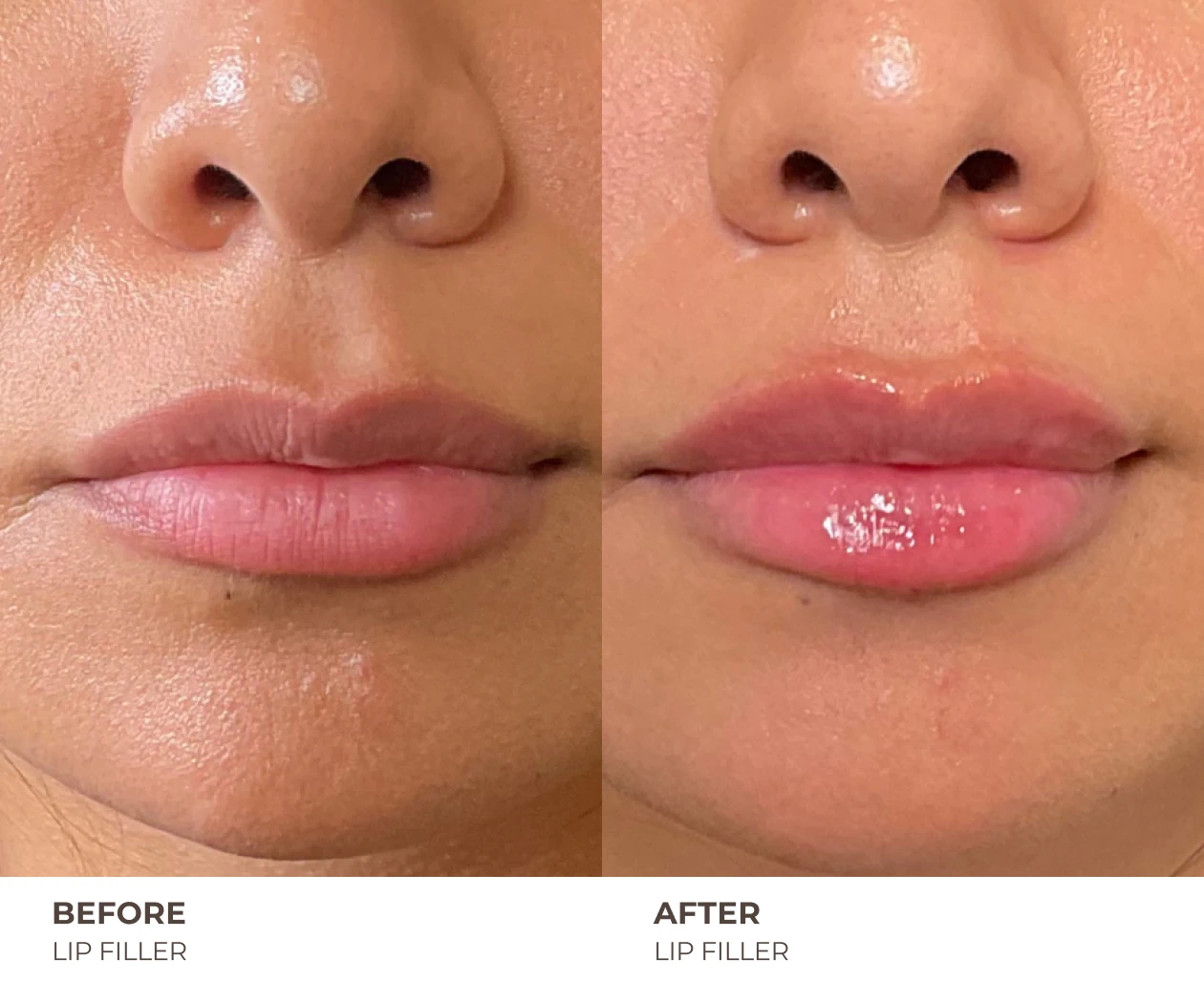 lip filler before and after