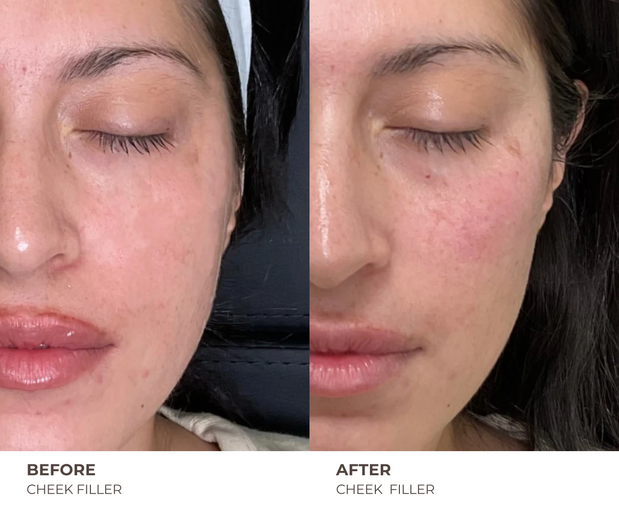 cheek fillers before and after