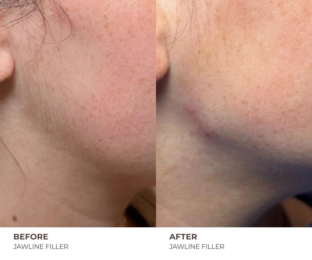 jawline filler before and after