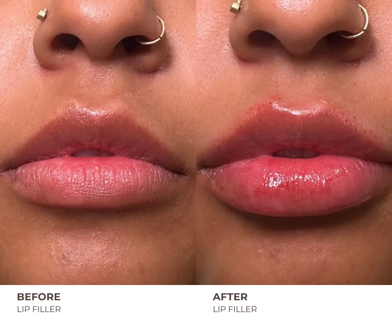 lip filler before and after