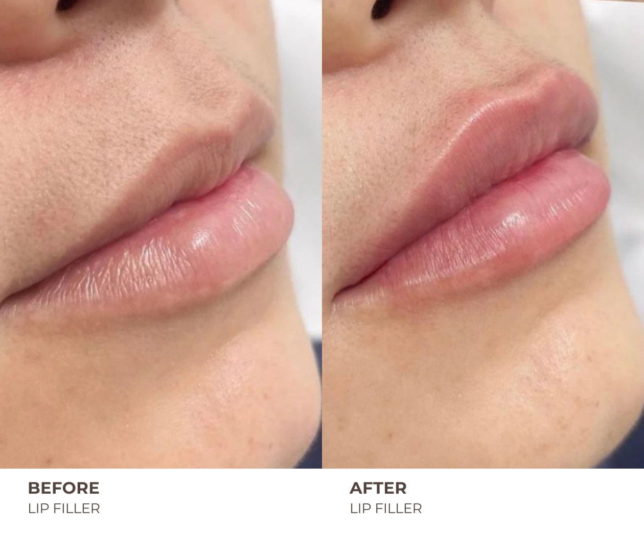 Lip Fillers before and after