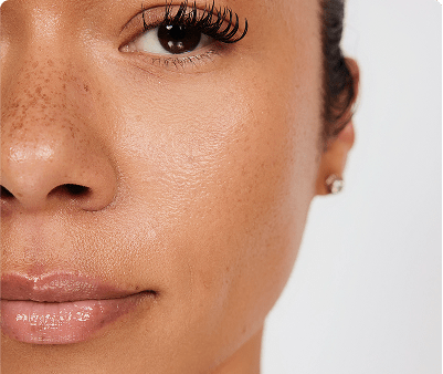 skinpen microneedling scar