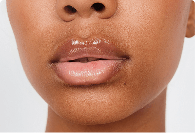 Lip Fillers