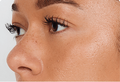 under eyes fillers