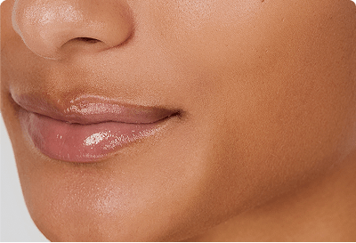 Smile line fillers