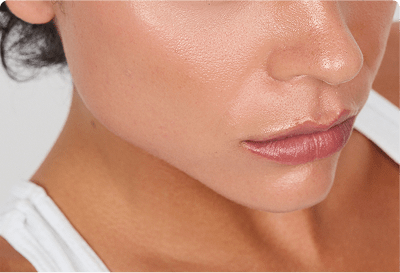 Jawline fillers