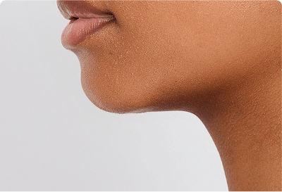 chin fillers