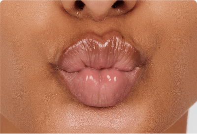 Lip line fillers