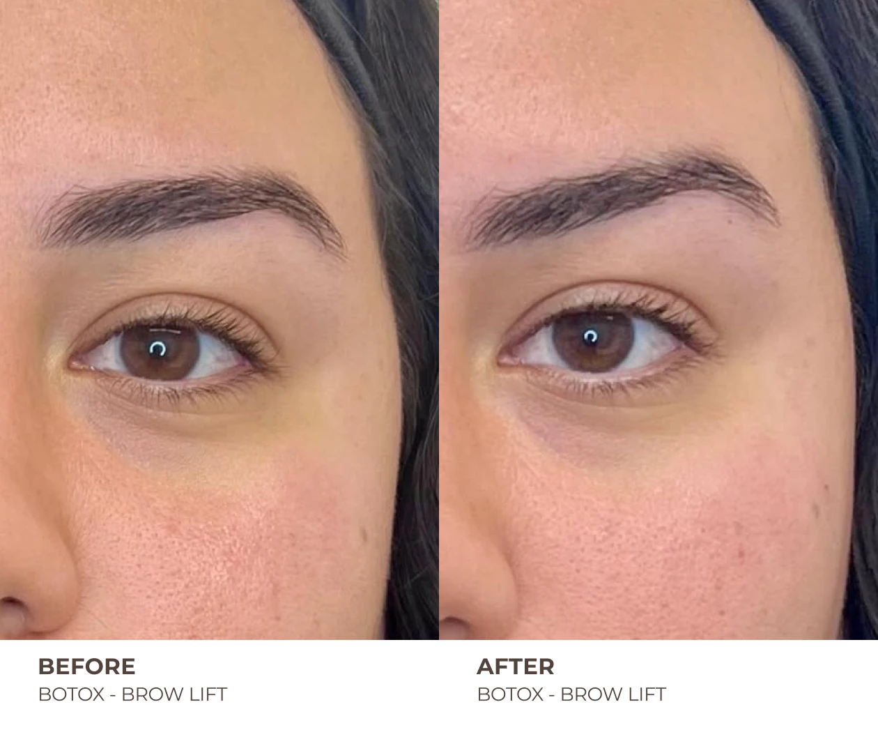 botox brow lift before and after