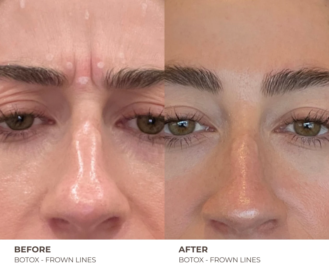botox frown lines before and after