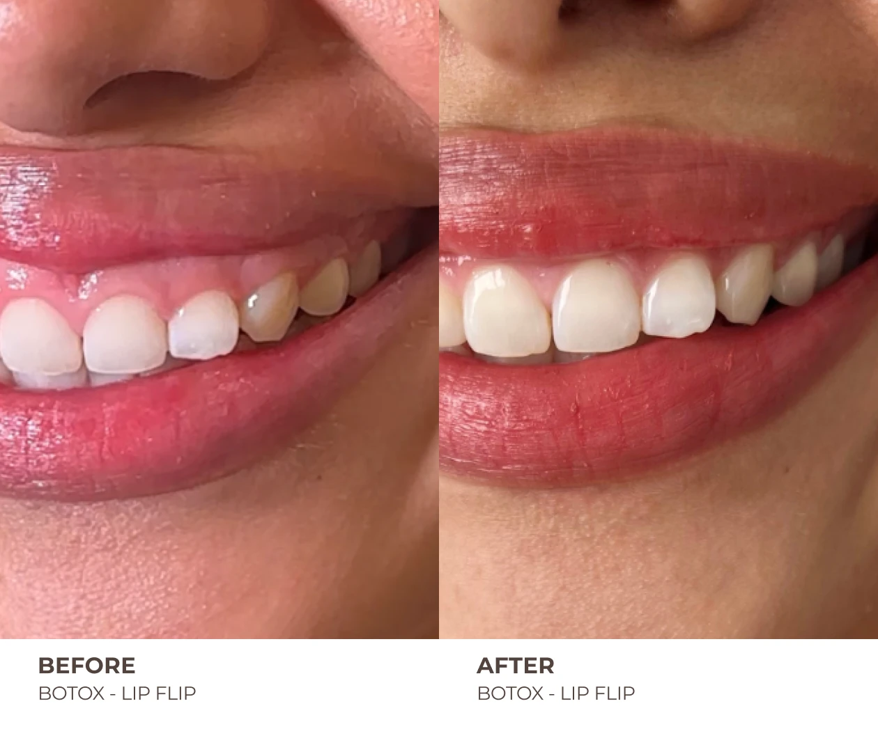 botox lip flip before and after