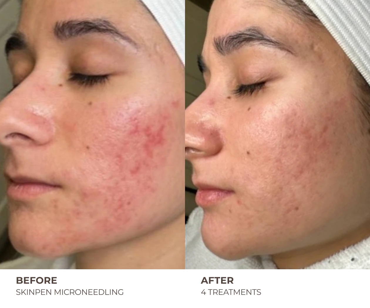 skinpen before and after treatment