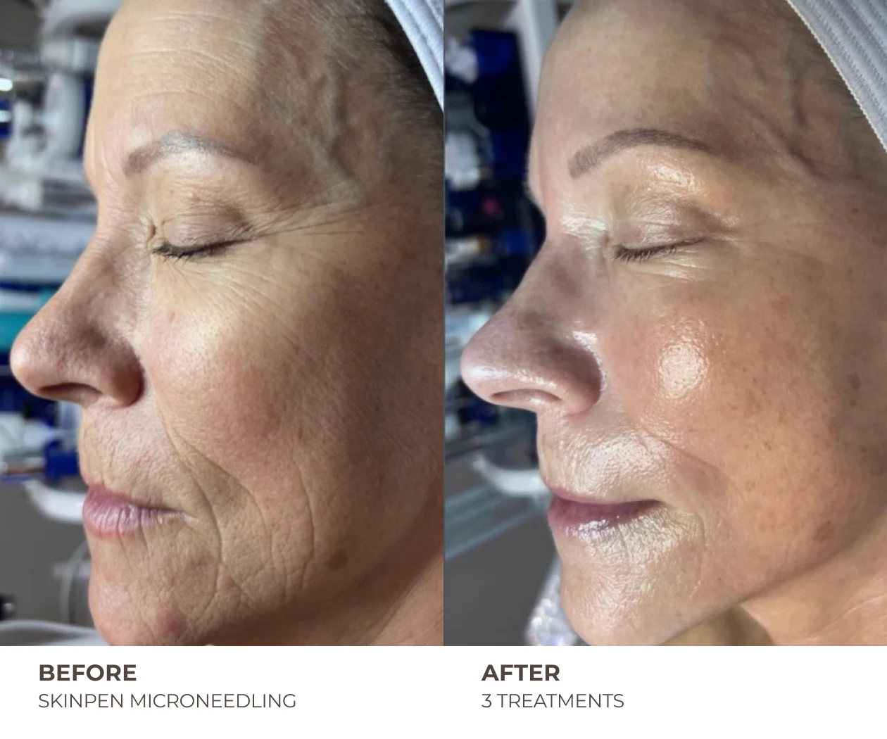 skinpen before and after treatment