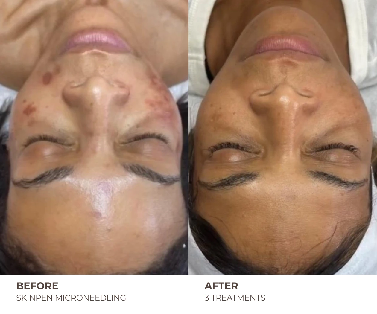 skinpen before and after treatment