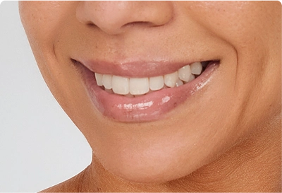 botox for visible gumline