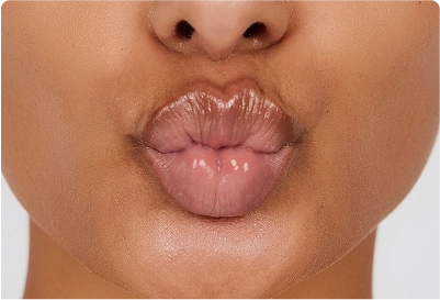 botox lip lines