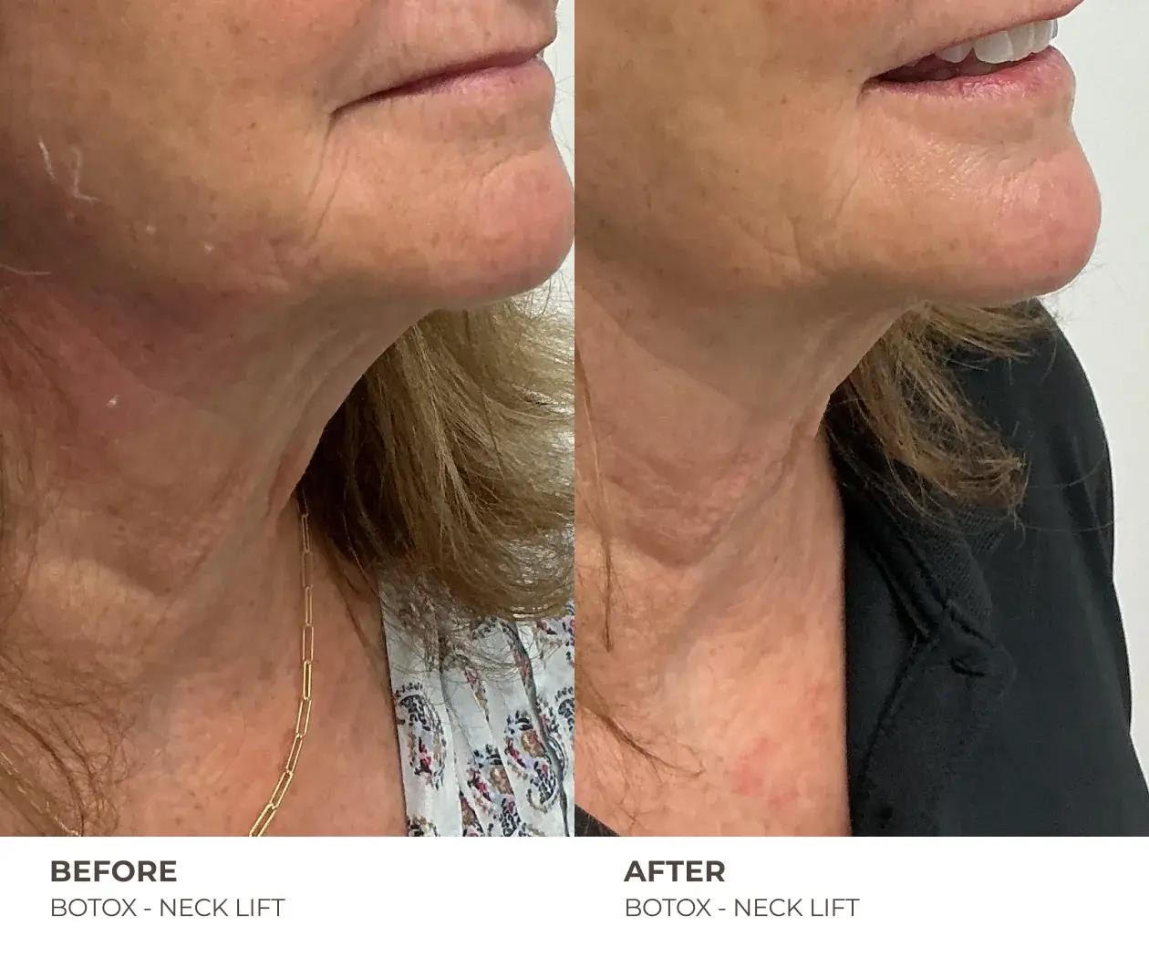 before and after neck lift
