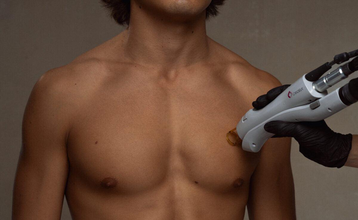 Laser Treatments for Men