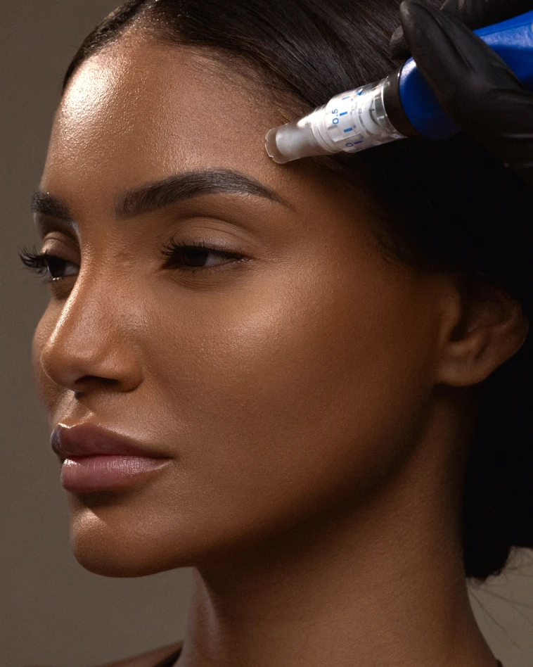 Skinpen microneedling