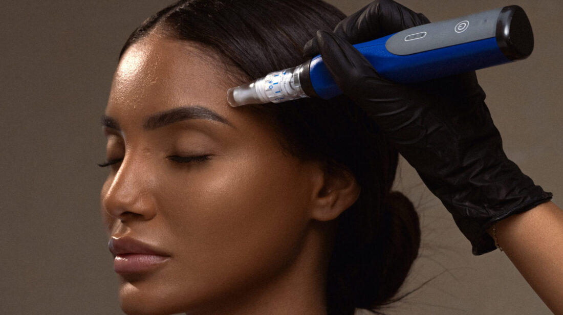 Microneedling for Stretch Marks