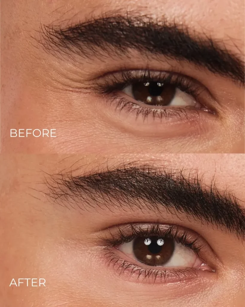 Botox for Crow’s Feet Before and after