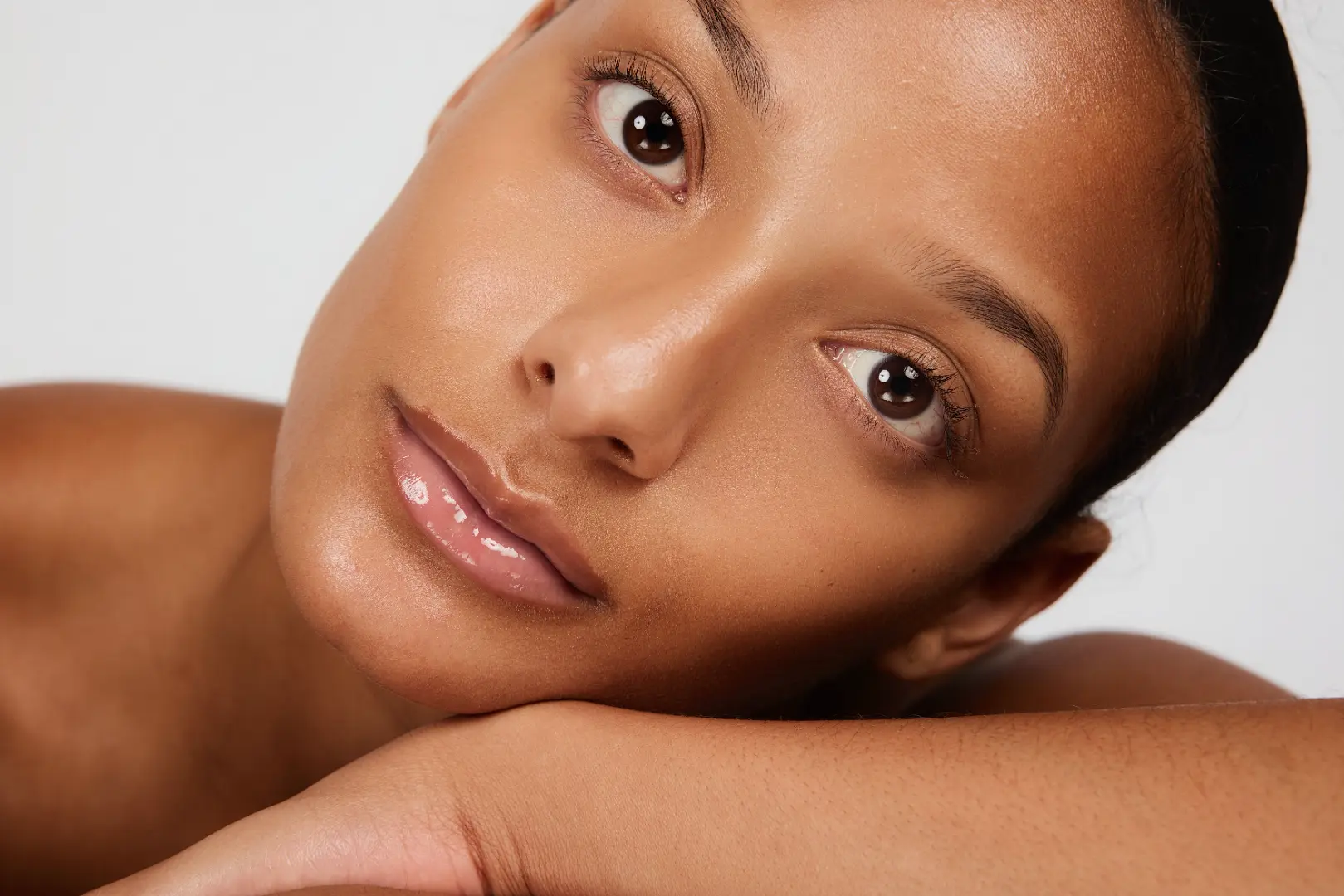 Microneedling for Acne Scars