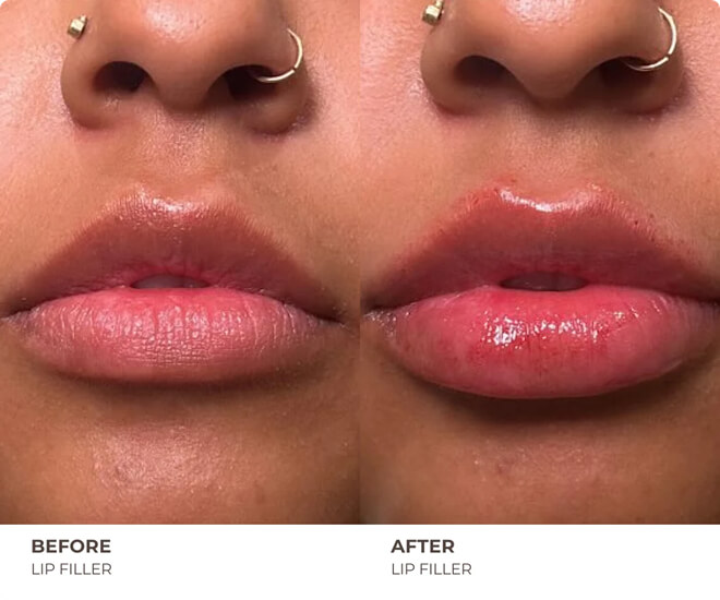lip fillers before and after results