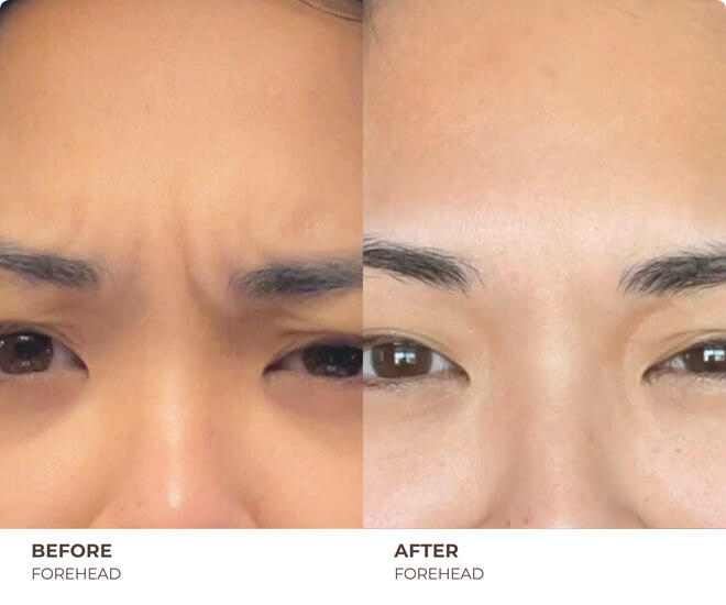 botox before and after
