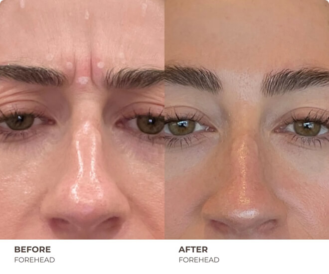 botox before and after results