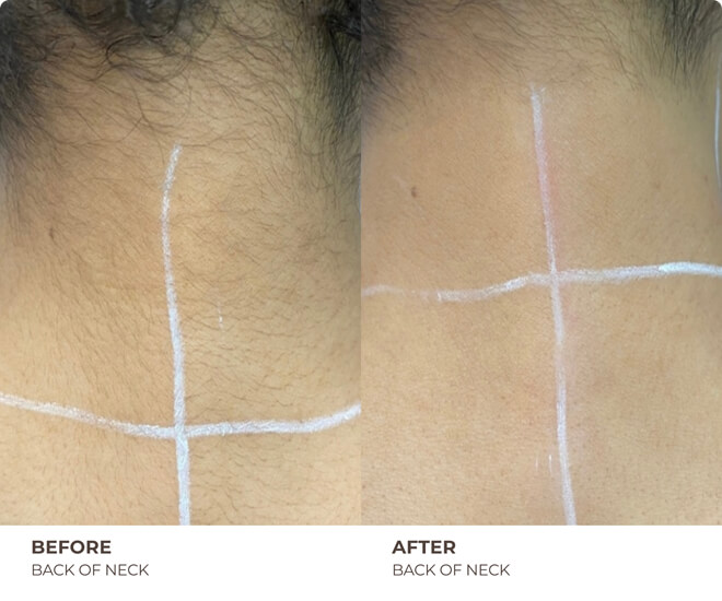 neck laser hair removal results