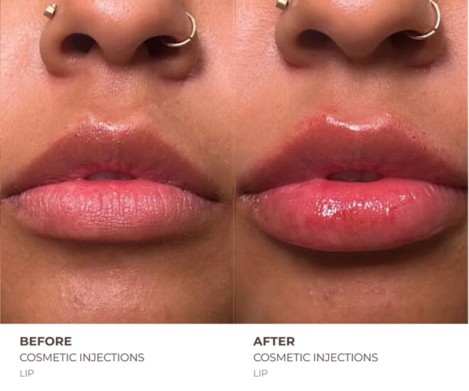 lip fillers before and after results