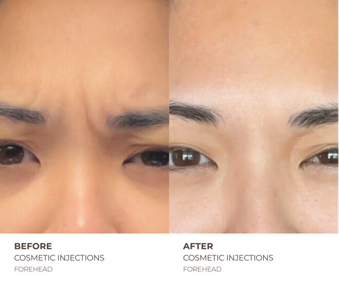 botox before and after