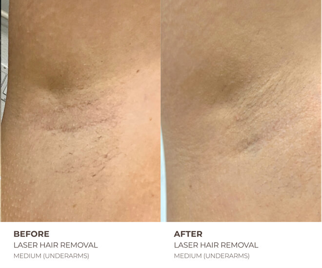 underarm laser hair removal before and after