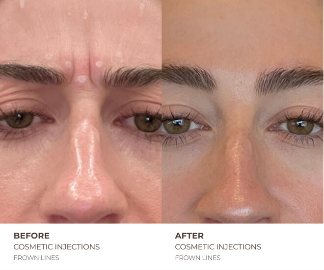 botox before and after
