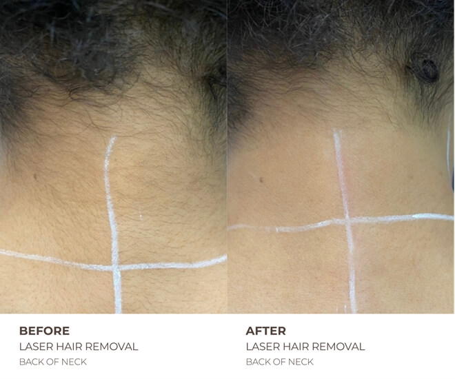 neck laser hair removal results