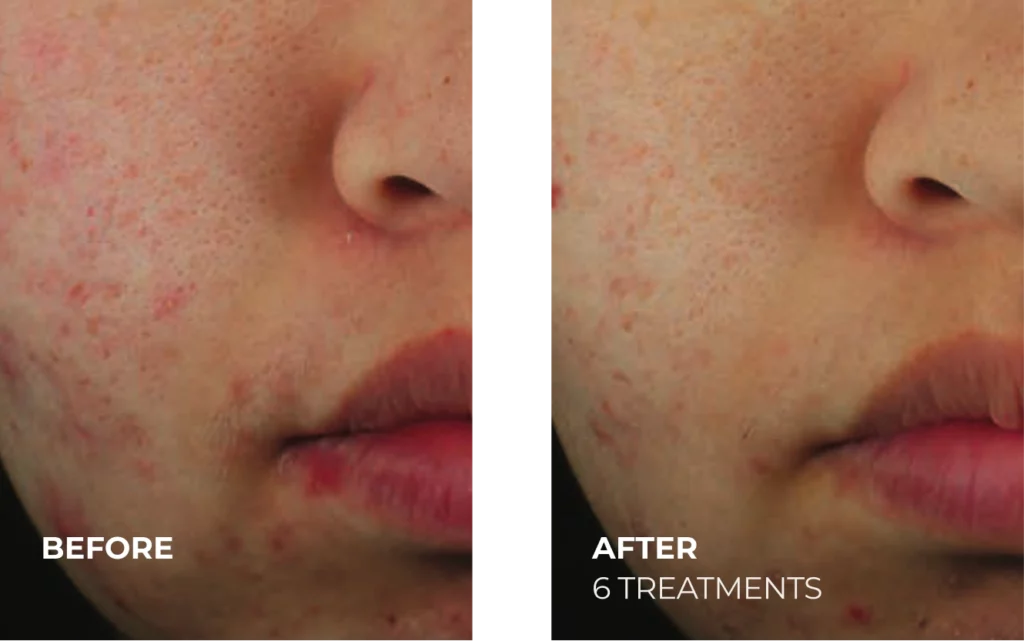 DiamondGlow® before and after